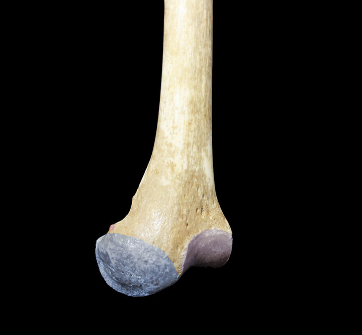 highlighted distal femur