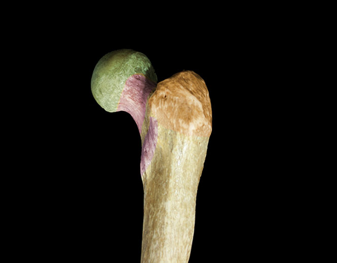 highlighted proximal femur